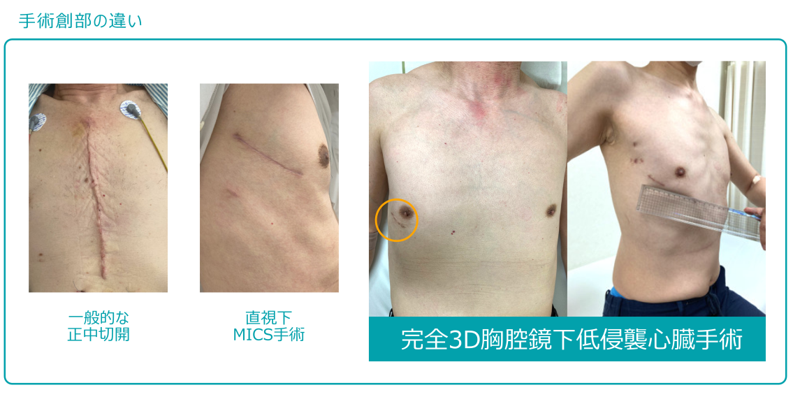低侵襲心臓手術（MICS）とは