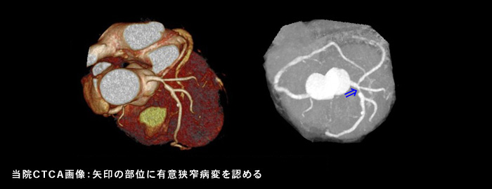 循環器内科による心臓CT検査