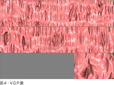 大腸がんのための大腸ＣＴ検査（ＣＴコロノグラフィー：ＣＴＣ）