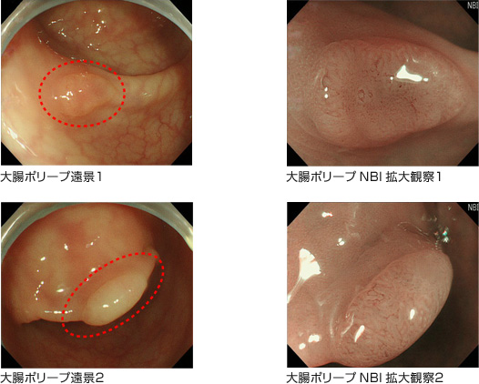 大腸ポリープ症例