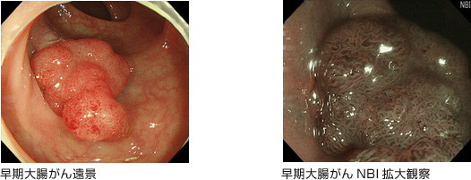 早期大腸がん症例