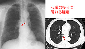 宇都宮記念病院の肺がん検診