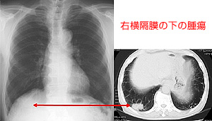 宇都宮記念病院の肺がん検診