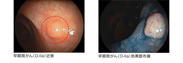 宇都宮記念病院の胃がん健診内視鏡検査