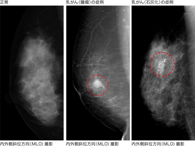 宇都宮記念病院の乳がんの症例