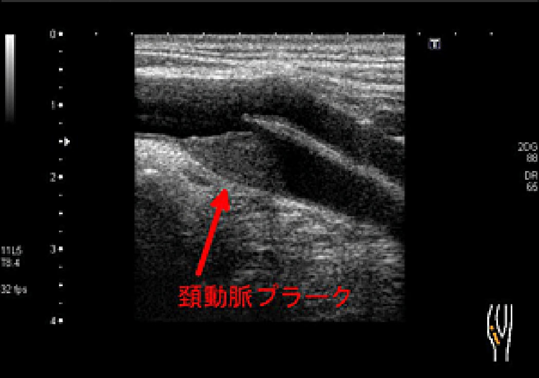 頚動脈プラークの例
