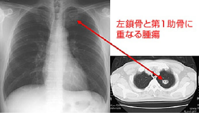 単純X線写真で発見困難な症例1