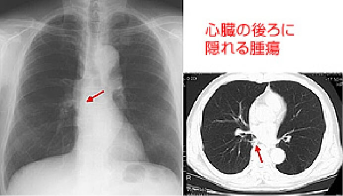 単純X線写真で発見困難な症例2