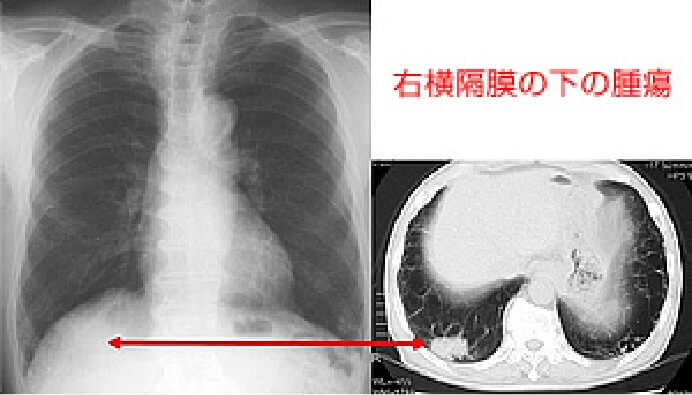 単純X線写真で発見困難な症例3