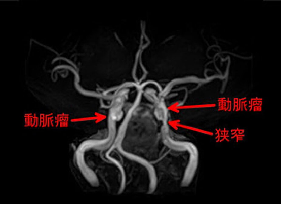 動脈瘤と狭窄の症例