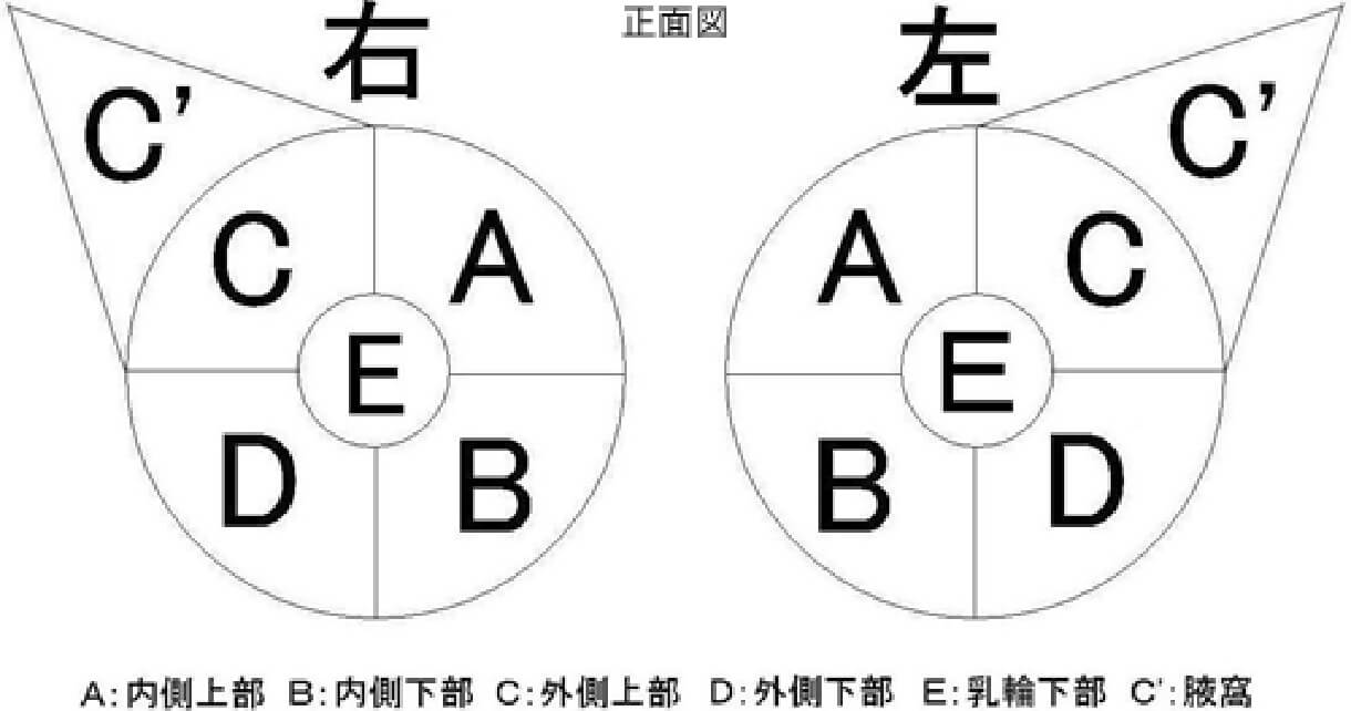 乳房腫瘤の局在分類