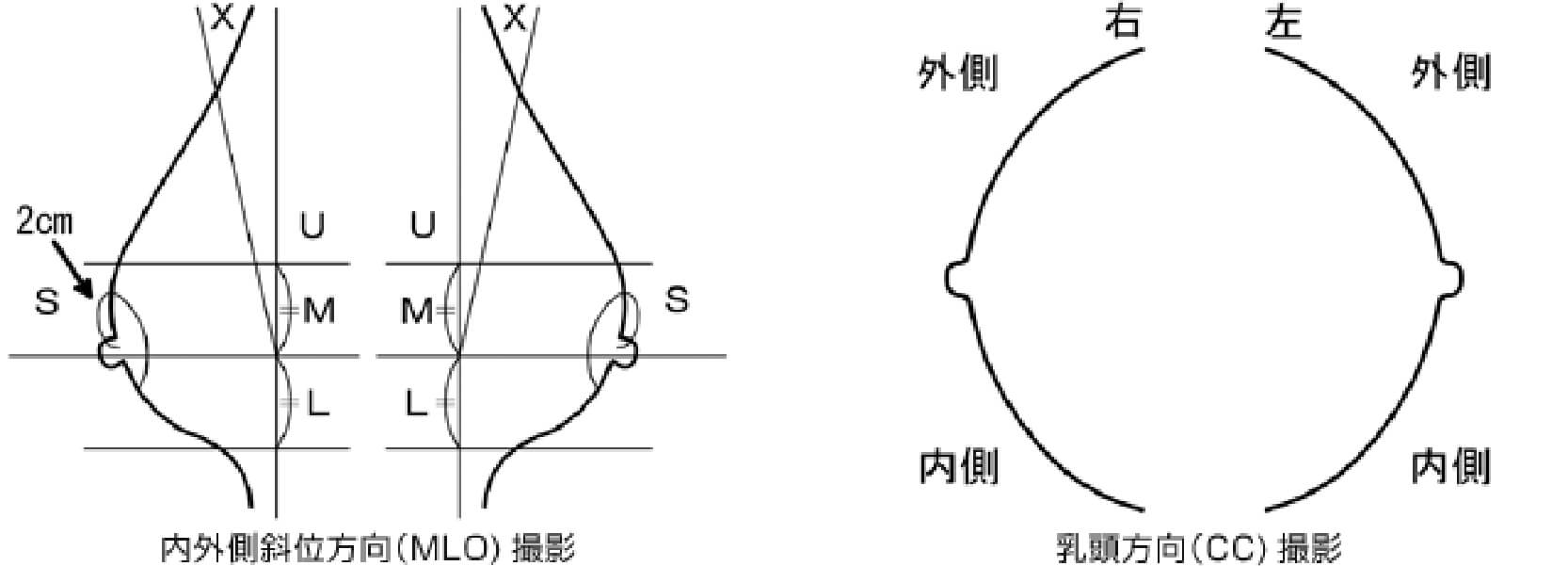 乳房X線(マンモグラフィ)の撮影方向