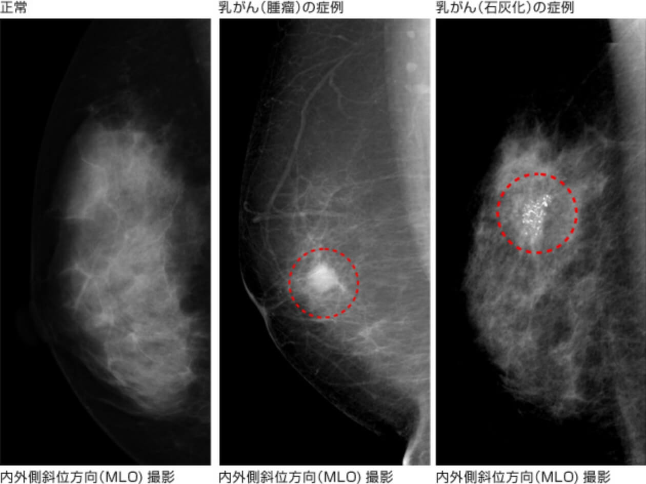 乳房X線(マンモグラフィ)による乳がんの症例