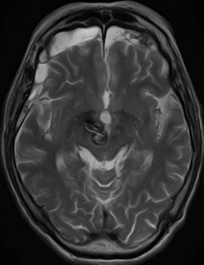 宇都宮記念病院 脳神経外科の血栓化動脈瘤の症例