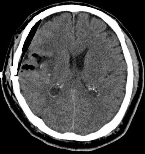 宇都宮記念病院 脳神経外科の脳出血の症例