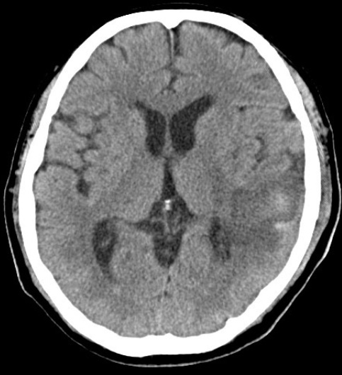 宇都宮記念病院 脳神経外科の脳出血の症例