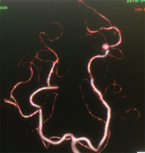 宇都宮記念病院の後大脳動脈末梢の動脈瘤の症例