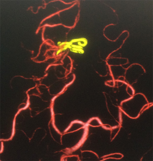 宇都宮記念病院の後大脳動脈末梢の動脈瘤の症例