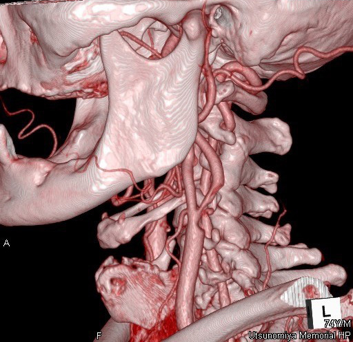 宇都宮記念病院 脳神経外科の頚動脈狭窄症にCASを施行した症例