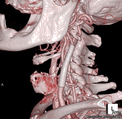 宇都宮記念病院 脳神経外科の頚動脈狭窄症にCASを施行した症例