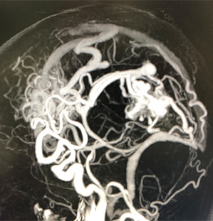 宇都宮記念病院の脳動静脈奇形の症例