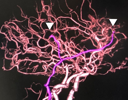 宇都宮記念病院 脳神経外科のもやもや病の症例