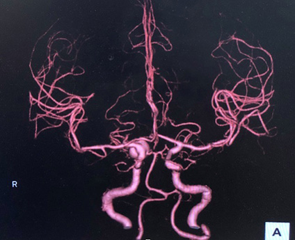 宇都宮記念病院の脳動脈留の症例
