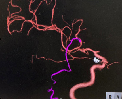 宇都宮記念病院の脳動脈留の症例