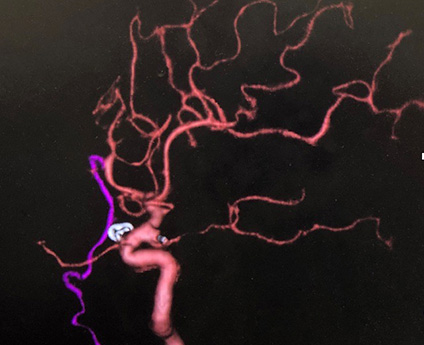 宇都宮記念病院の脳動脈留の症例