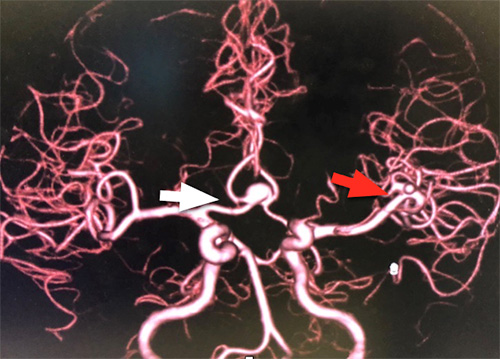 宇都宮記念病院の多発脳動脈瘤の症例