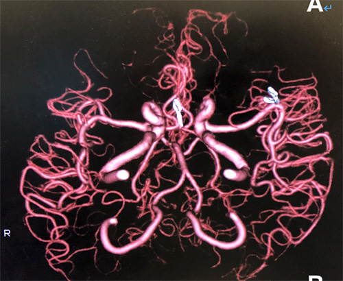 宇都宮記念病院の多発脳動脈瘤の症例