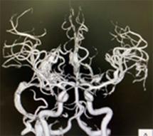 宇都宮記念病院の脳動静脈奇形の症例