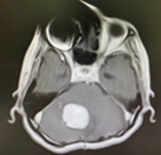 宇都宮記念病院の小脳血管芽腫瘍の症例