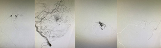 宇都宮記念病院の小脳血管芽腫瘍の症例