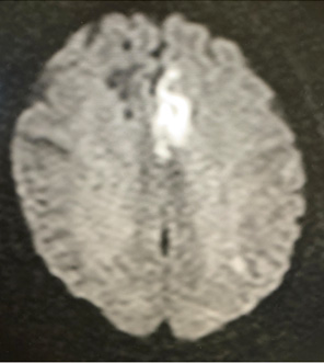 宇都宮記念病院の脳動脈解離の症例