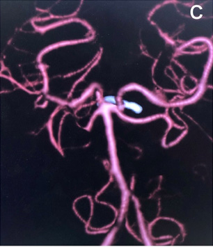 宇都宮記念病院の脳底動脈瘤の症例