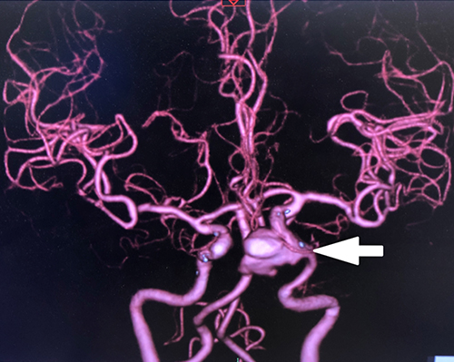 宇都宮記念病院の巨大脳動脈瘤の症例