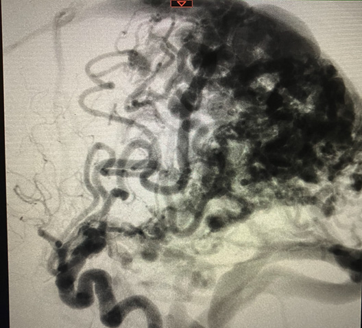宇都宮記念病院の脳動静脈奇形の症例