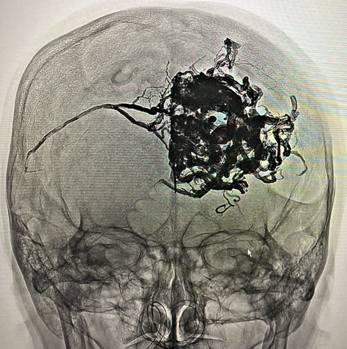 宇都宮記念病院の脳動静脈奇形の症例