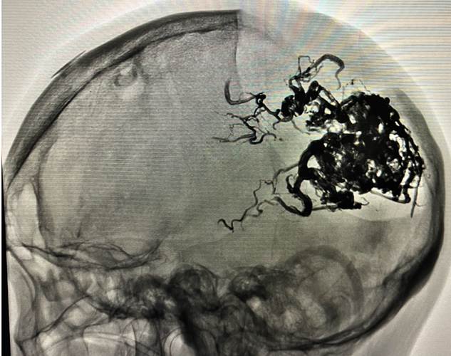 宇都宮記念病院の脳動静脈奇形の症例
