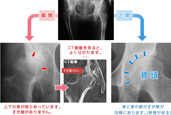 正常と異常な股関節のCT画像