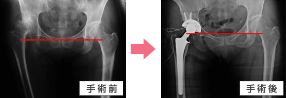 宇都宮記念病院での股関節手術の前後