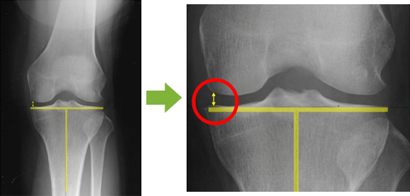 変形性膝関節症のない正常な膝の例