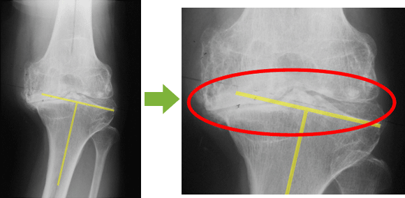 宇都宮記念病院での変形性膝関節症の例