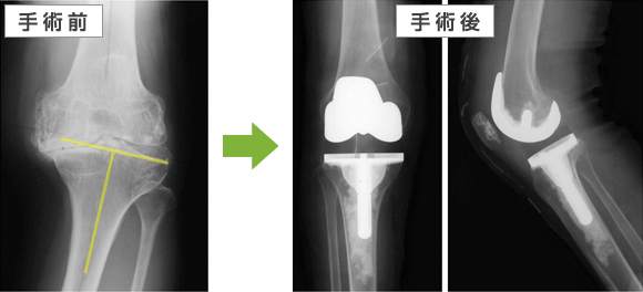 宇都宮記念病院で人工膝関節置換術による例