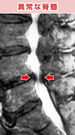 脊柱管狭窄症、坐骨神経痛、椎間板ヘルニアなどの異常な脊髄