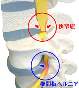 狭窄症・椎間板ヘルニアの原因