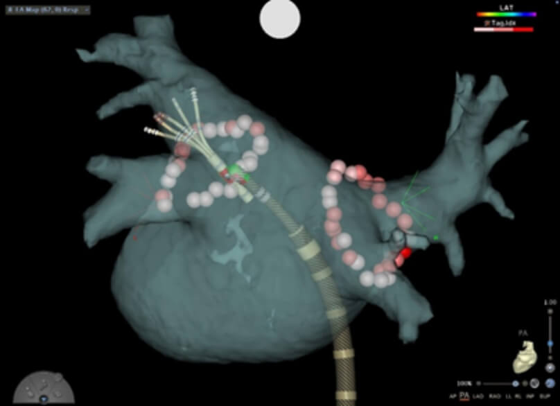 カテーテルアブレーション