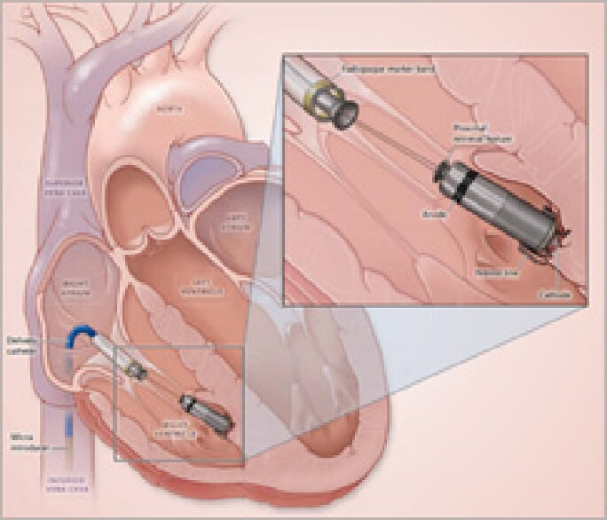 リードレスペースメーカ