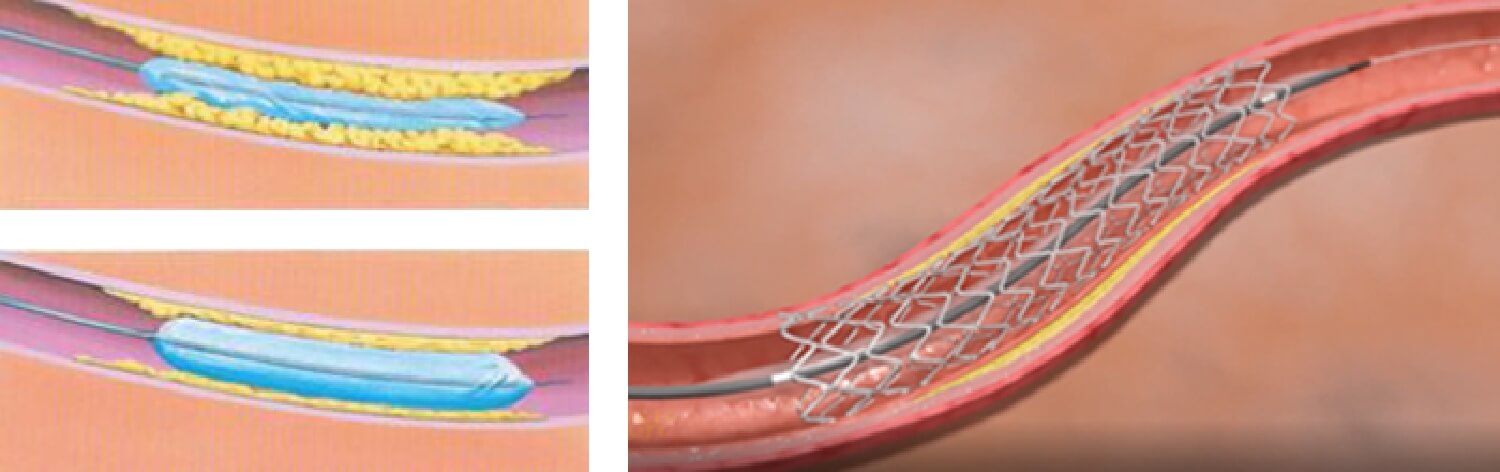 心臓カテーテル検査（CAG）